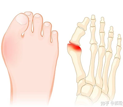 Hallux Valgus: دليل علمي كامل