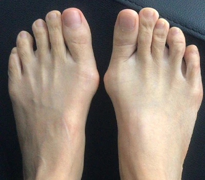 قياس Hallux Valgus: لماذا الماسحات الضوئية ثلاثية الأبعاد تفوق الأطباء والمستشفيات