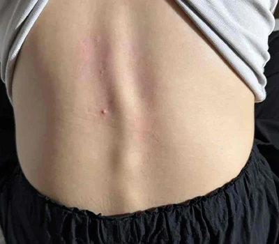 تحليل شامل للجنف: فهم الحالة والابتكارات التكنولوجية في التقييم والإدارة